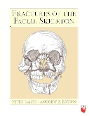 Fractures of the Facial Skeleton