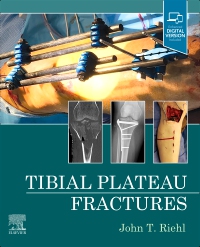 cover image - Tibial Plateau Fractures,1st Edition